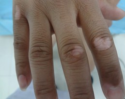 治疗小孩白斑较为安全的方法是什么?