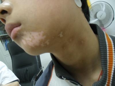 孩子脸上长白斑,究竟是谁的错!