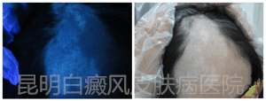 14岁女生额头患白癜风,在我院康复