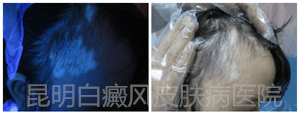 14岁女生额头患白癜风,在我院康复