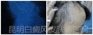 14岁女生额头患白癜风,在我院康复