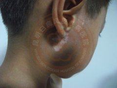 儿童患白癜风的原因有哪些?